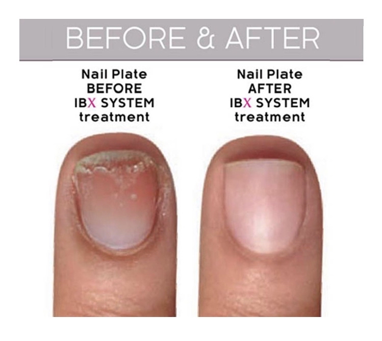 IBX Repair Treatment