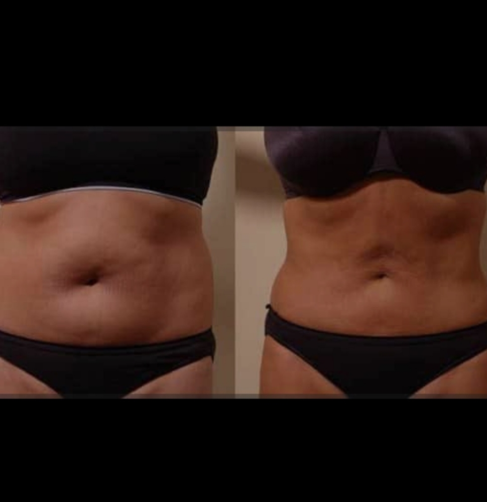 Low Level Laser Lipo