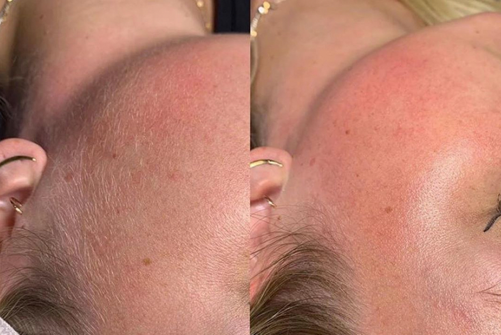 Dermaplaning with Facial at Evolve Esthetics in Meridian, ID