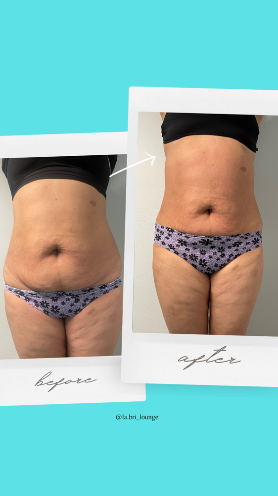 Tummy Tightening Package