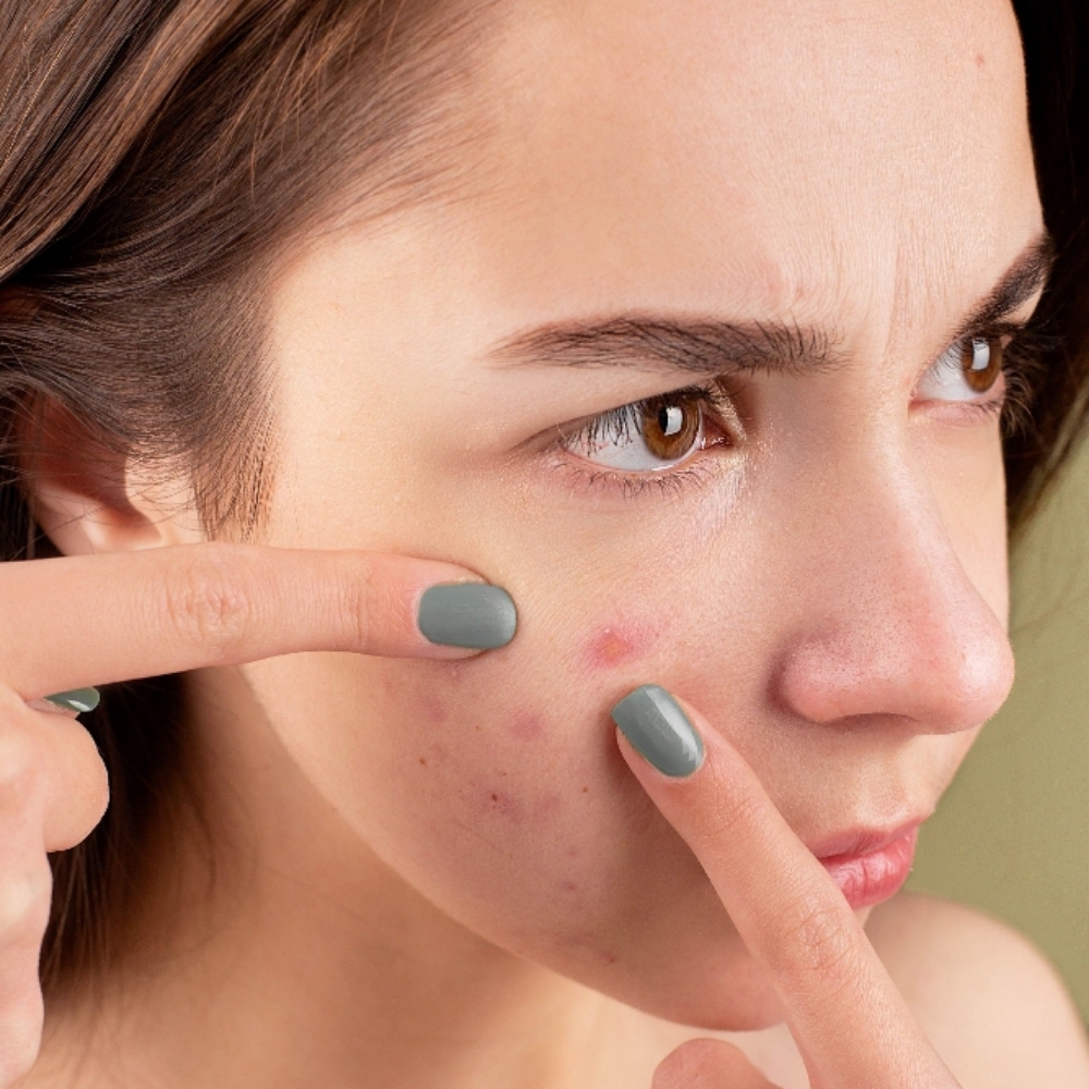 Zit-uation Under Control at Pore Decisions Esthetics LLC in Hinesville, GA