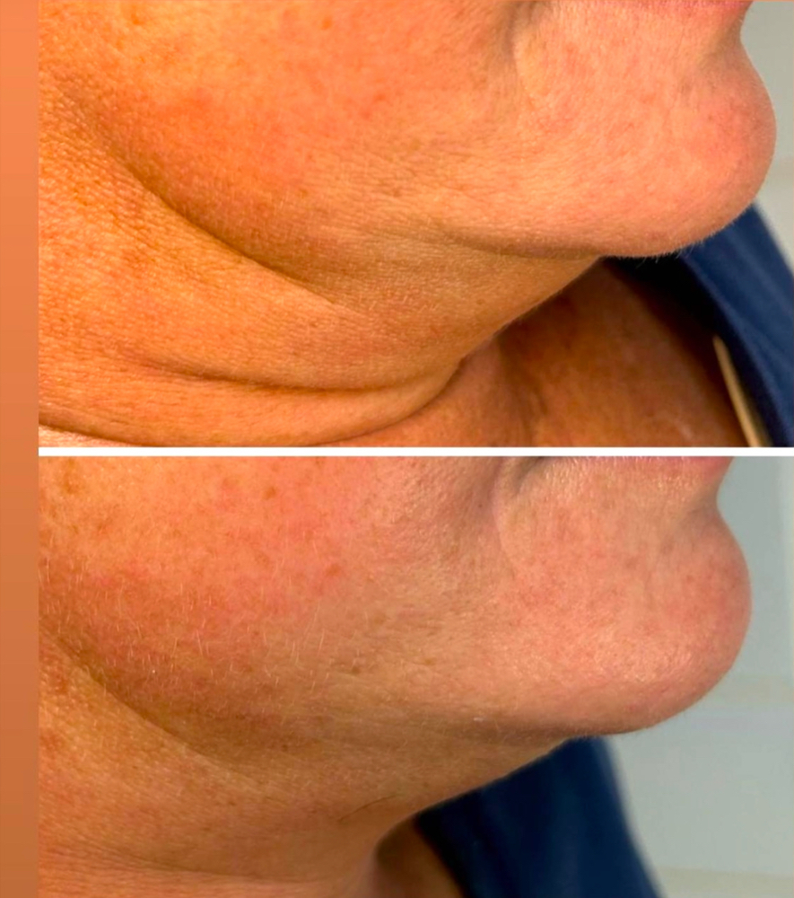Double Chin Blast