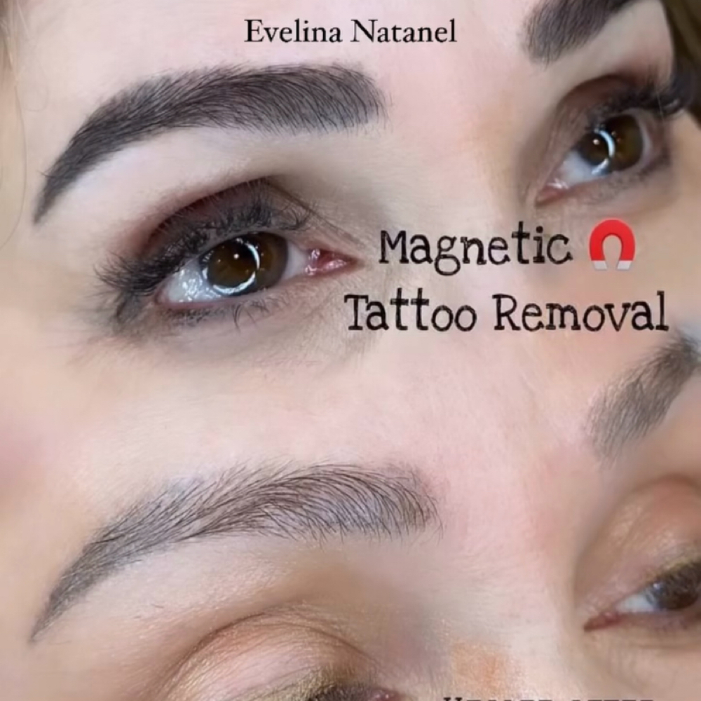 Magnetic Tattoo Removal at Body Contouring & More in Modesto, CA