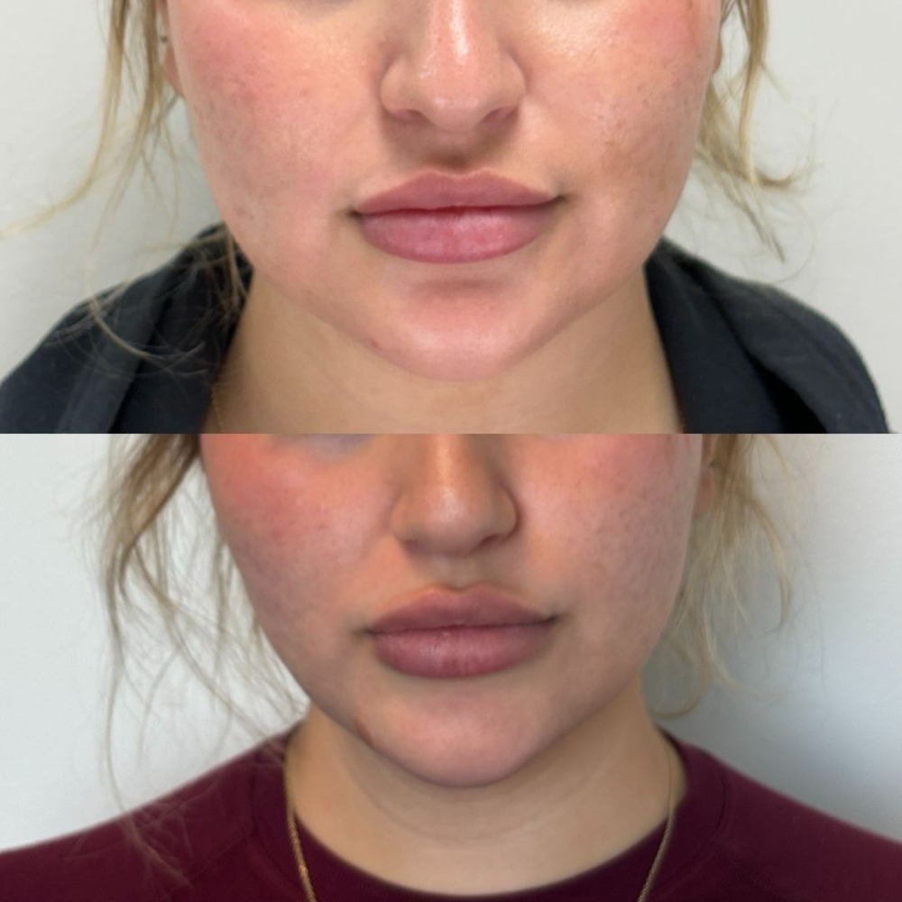 Full Lower Face Treatment at Lilli Aesthetics LLC in Mansfield, TX