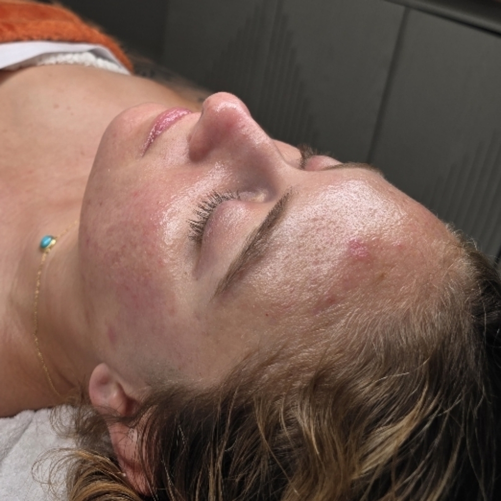 A1 Microchanneling Facial at Stephs A1 Beauty Bar in Southwest Ranches, FL