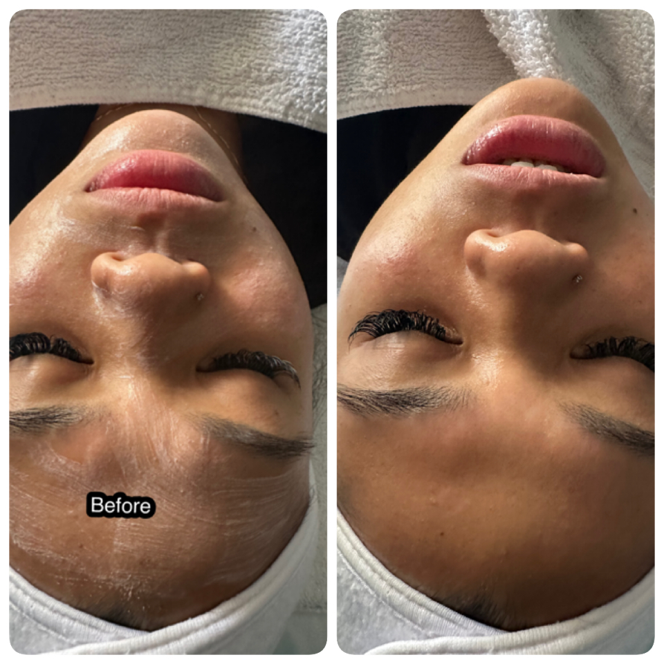 SiMonet Chemical Peel