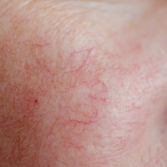 Broken Capillaries Removal at Serenity Aesthetics by Denise in St. John’s, FL