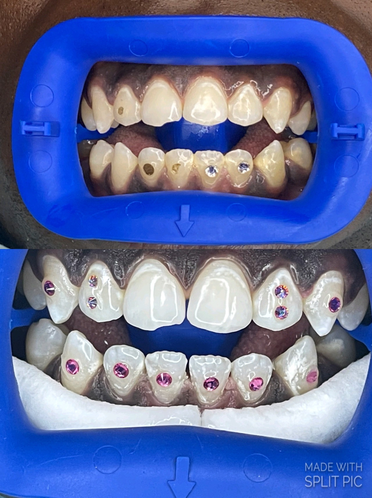 Laser Teeth Whitening