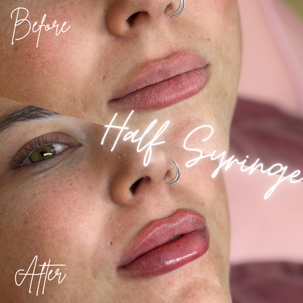 1/2 Dermal Lip Filler💋💉 at BeautyHolic Aesthetics LLC in Lubbock, TX