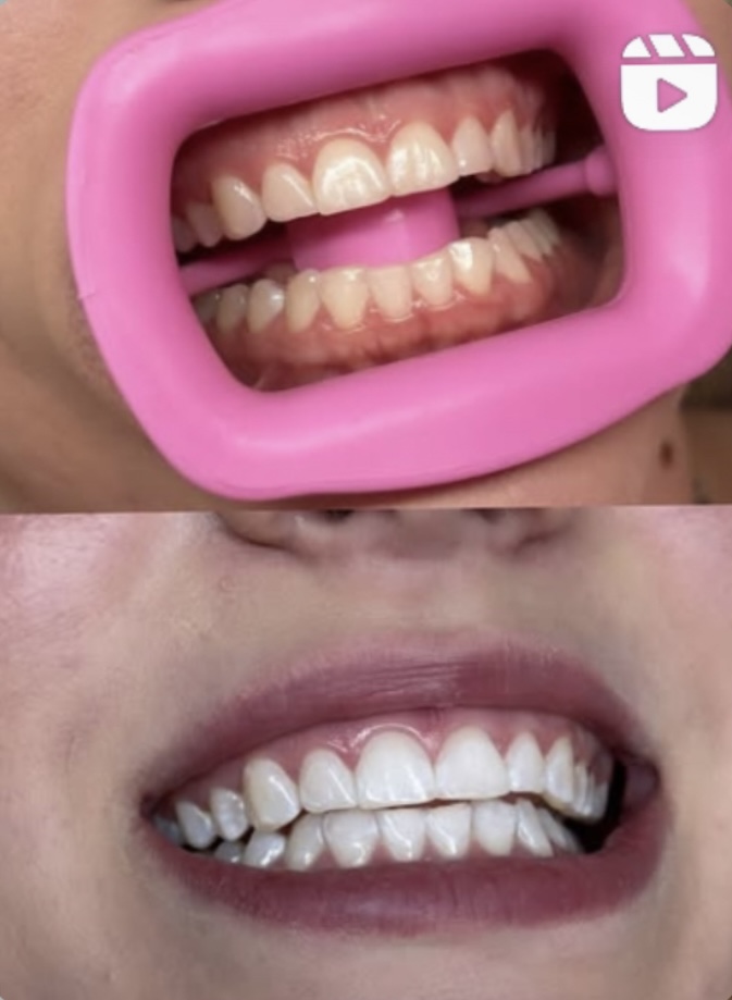 Teeth Whitening 60 Mins
