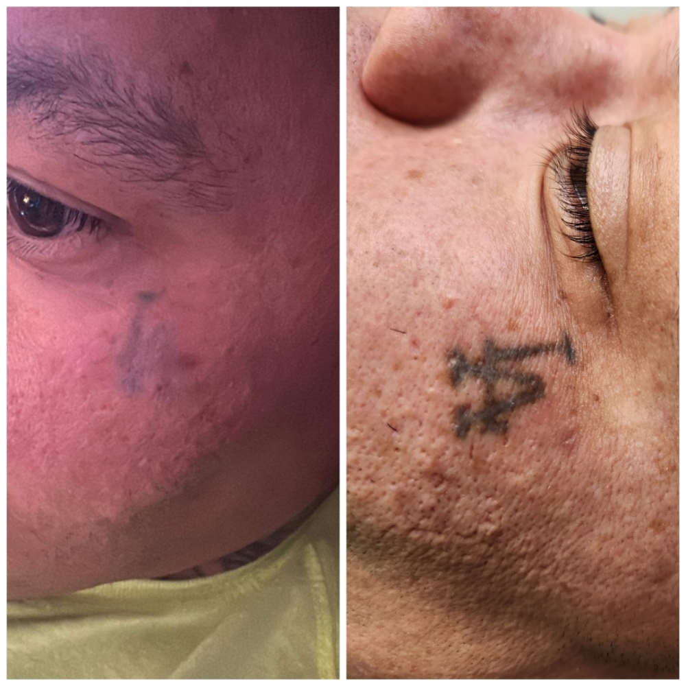 SALINE TATTOO REMOVAL