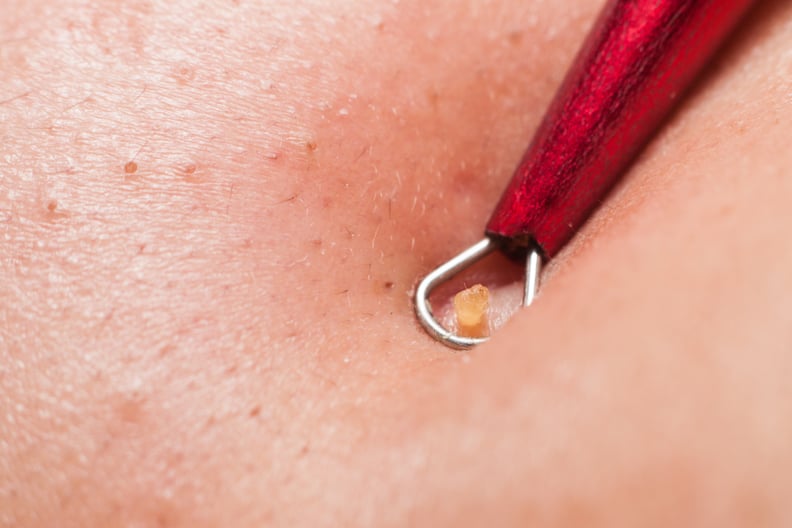 Extractions