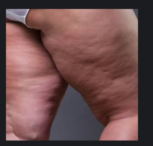 Cellulite Reduction Inner Thigh Pac
