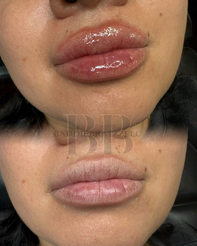 Dermal Filler Dissolve