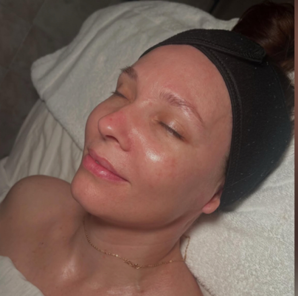 Acne Relief at The Layer & The Spell by Rexstyles in Point Pleasant Beach, NJ