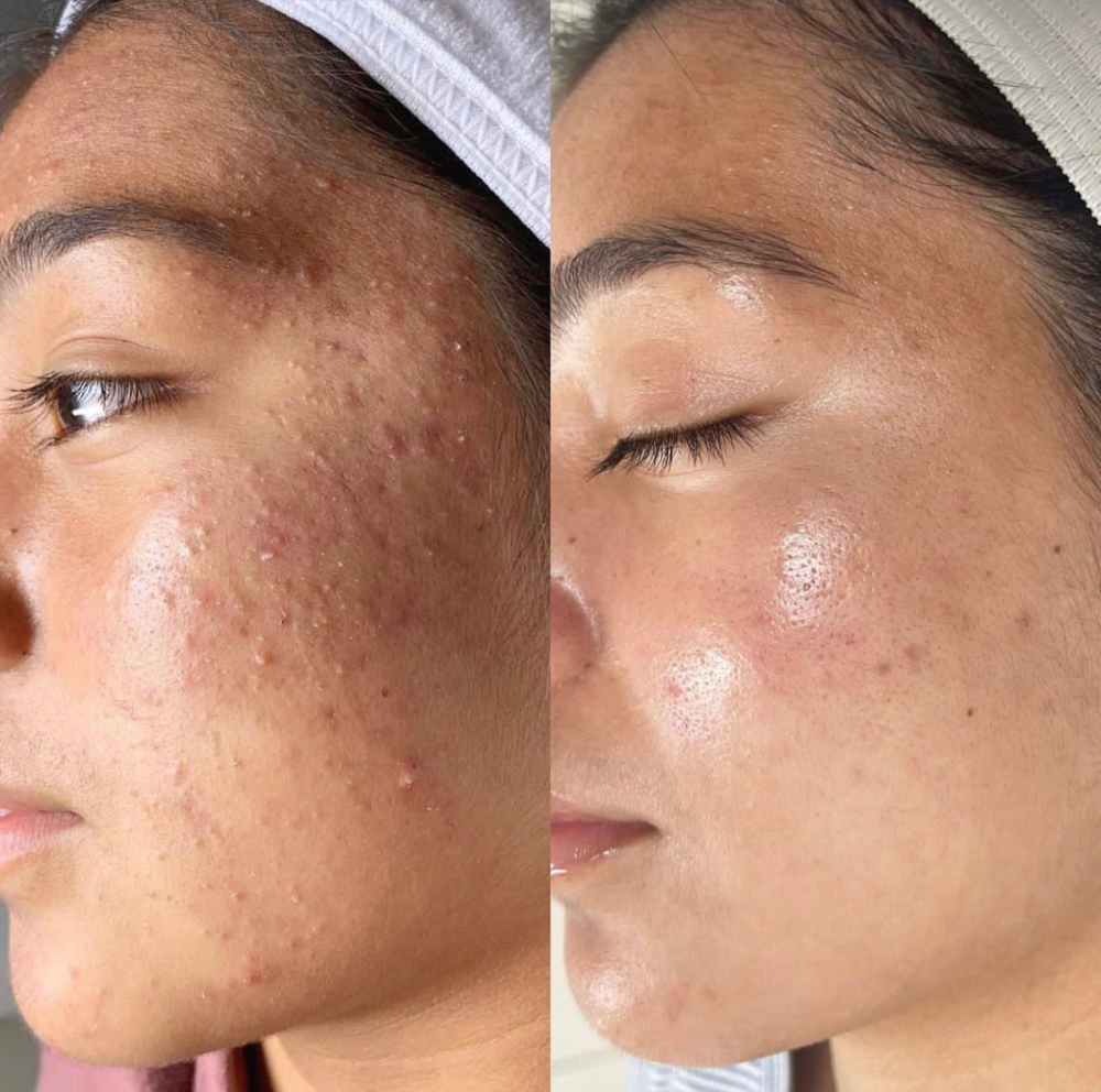 Acne Facial