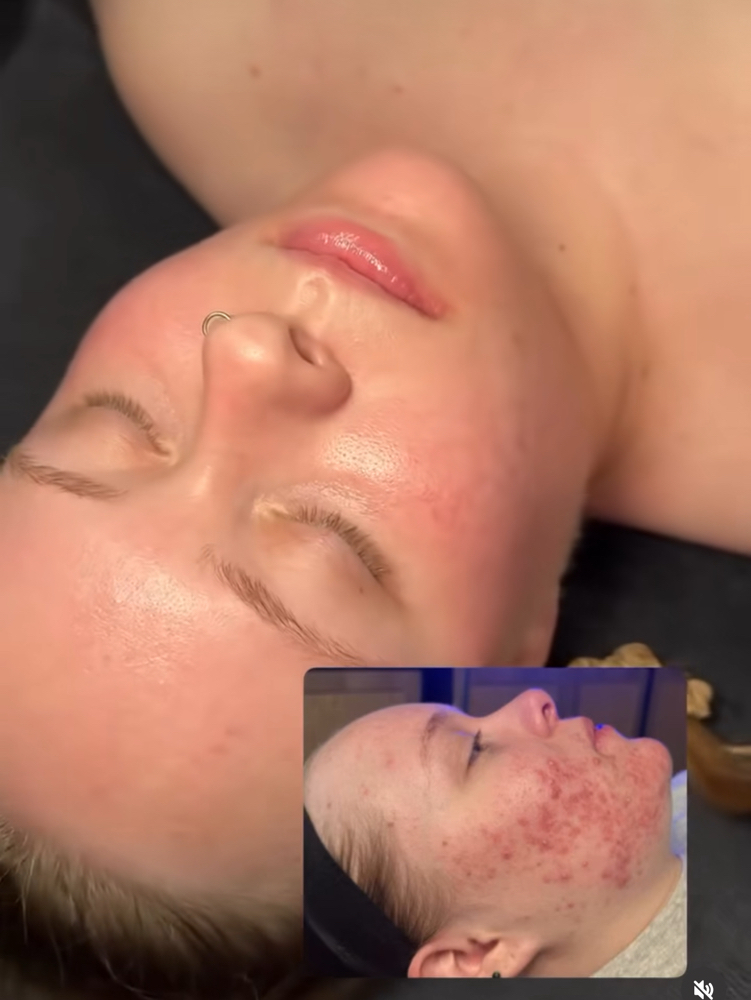 Face Reality Acne Bootcamp Facial