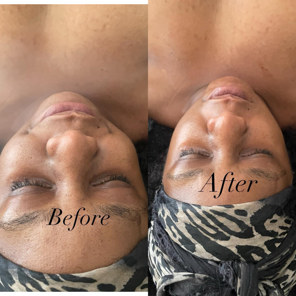 Facial