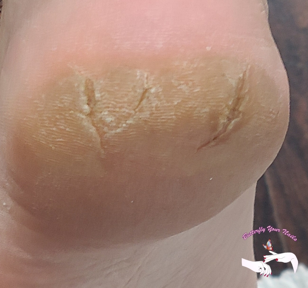 Callus Treatment Only
