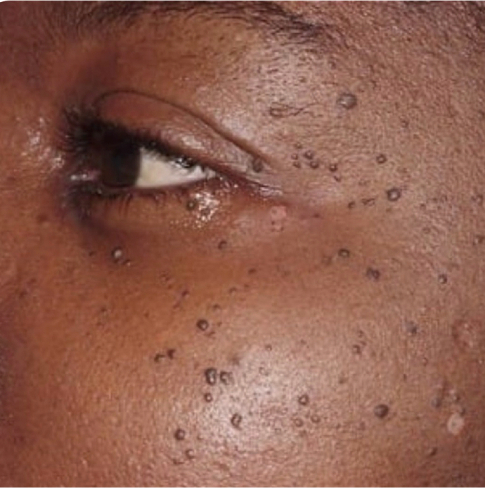 Skin Imperfection Face at The Art of Glow by Chelle in New York, NY
