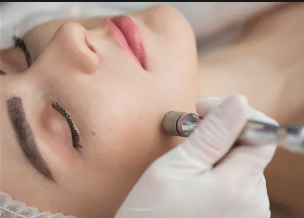 Microdermabrasion