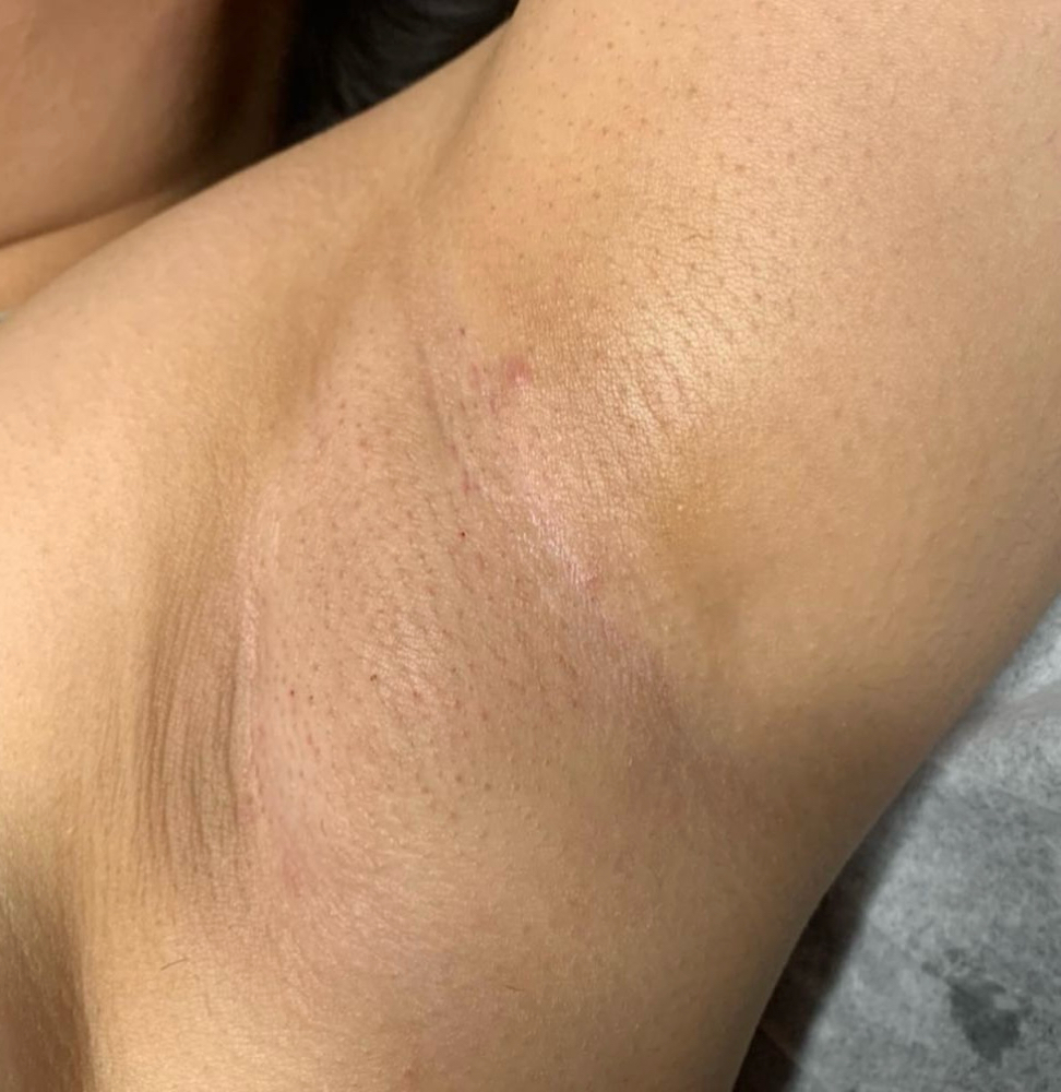 Underarms