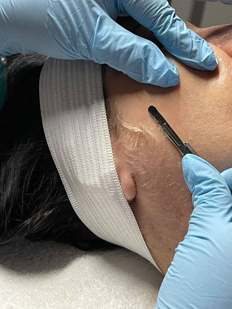 Dermaplaning