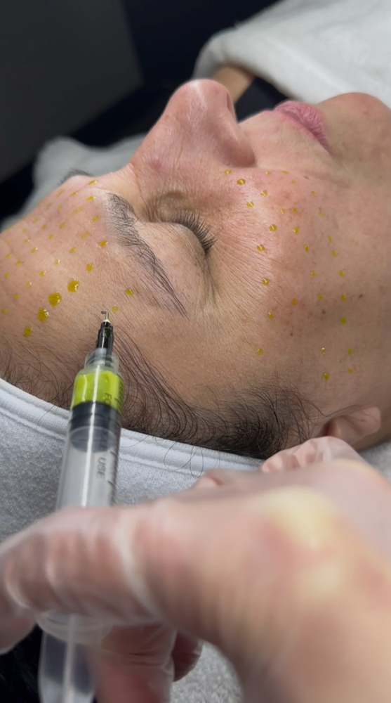 BioRePeel Facial