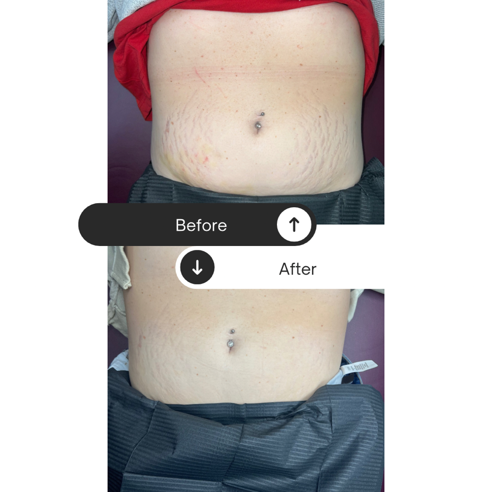 Inkless Stretchmark Revision
