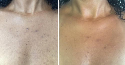Alpa Beta Chemical Peel Larger Area