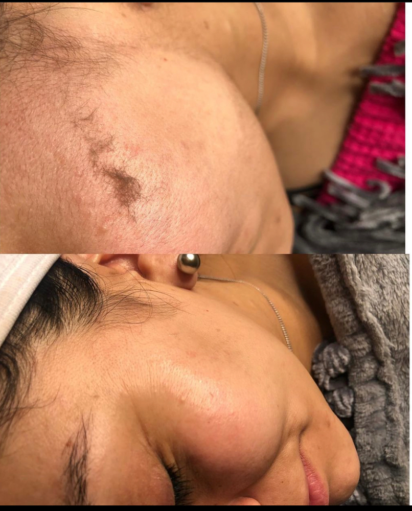 Dermaplane Facial