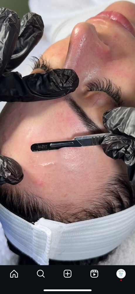 Dermaplaning