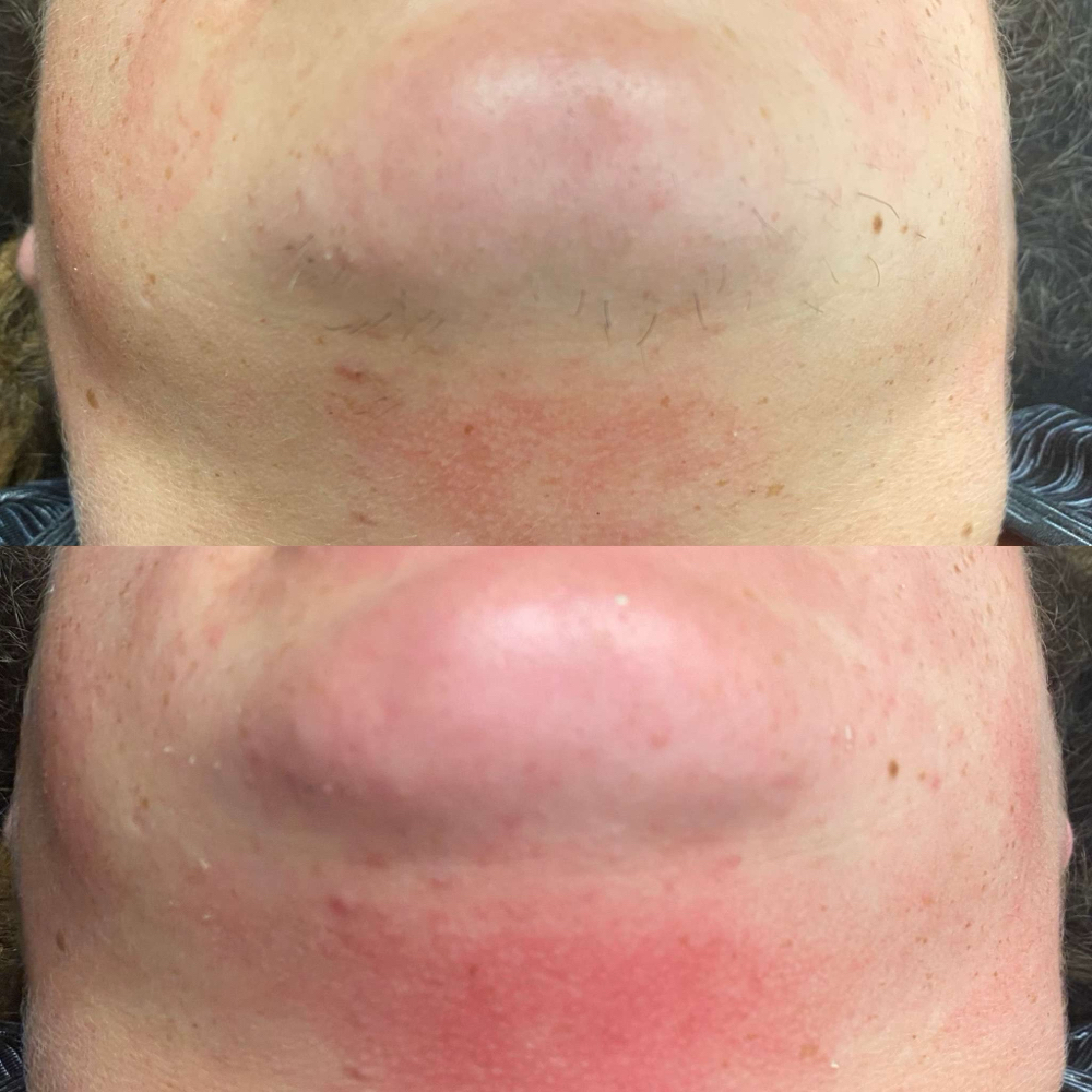 Facial Waxing