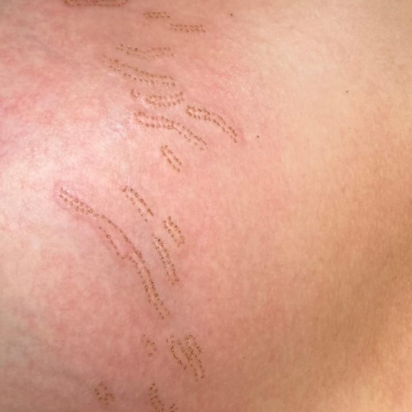Stretch mark removal at Windys Beauty Studio LLC in Virginia Beach, VA