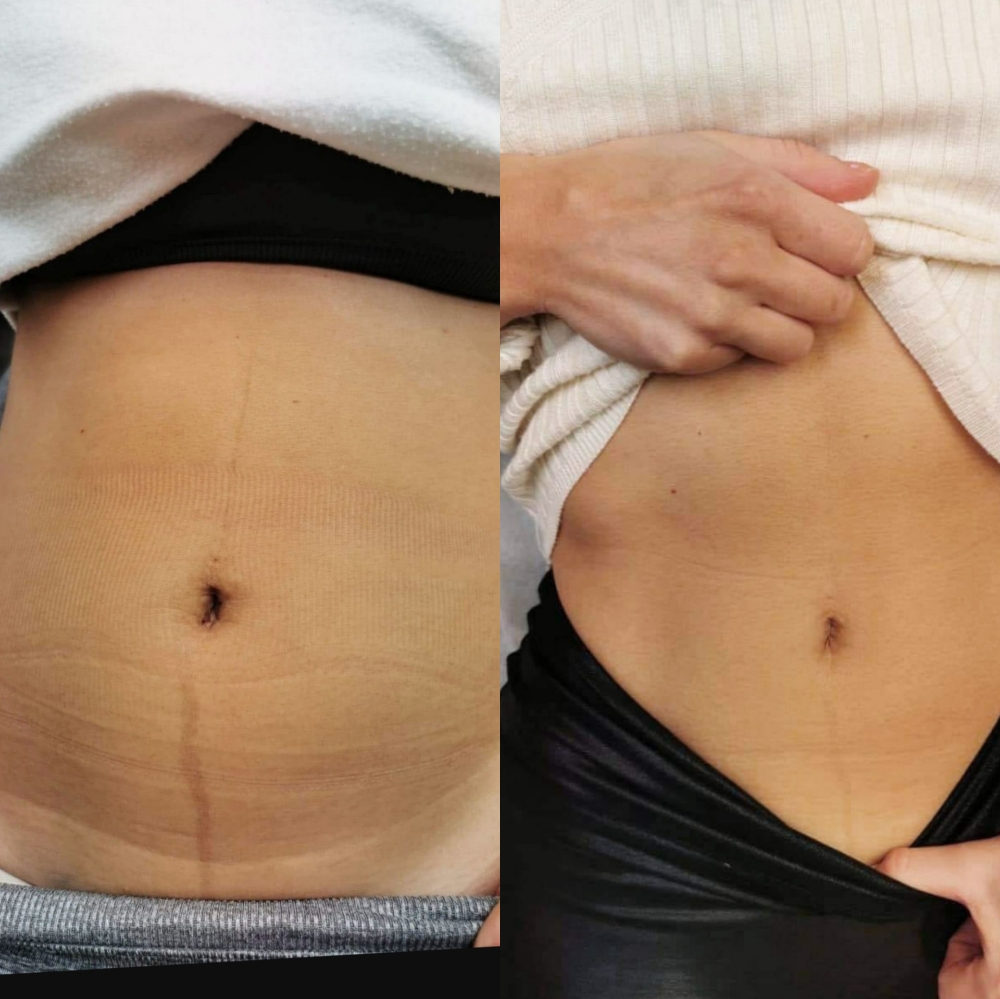 Scar Treatment Series