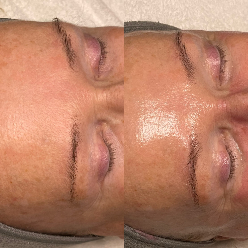 Angel Skin Chemical Peel