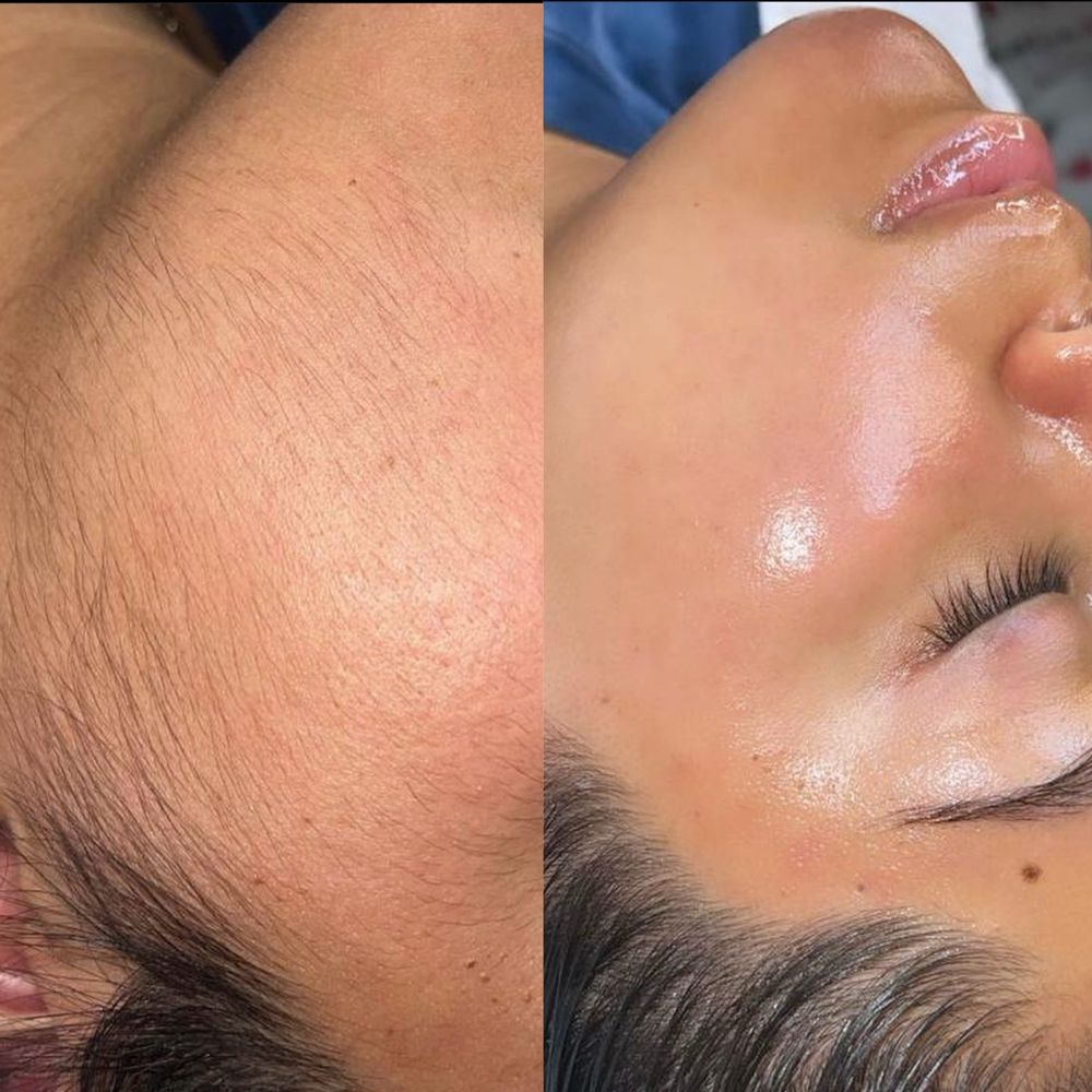 Dermaplaning