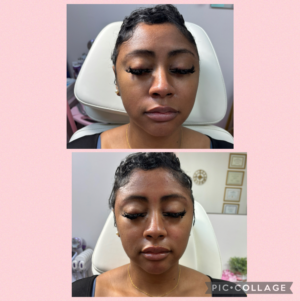 Follow Up Post Procedure at The Beautyful Secret in La., LA