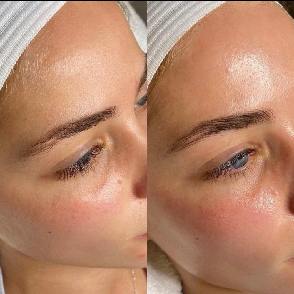 Dermaplaning Facial Membership at By Jess LLC in Pittsburg, CA