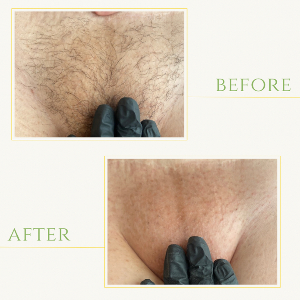 Brazilian Wax at Rich Care Esthetics in Winston Salem, NC
