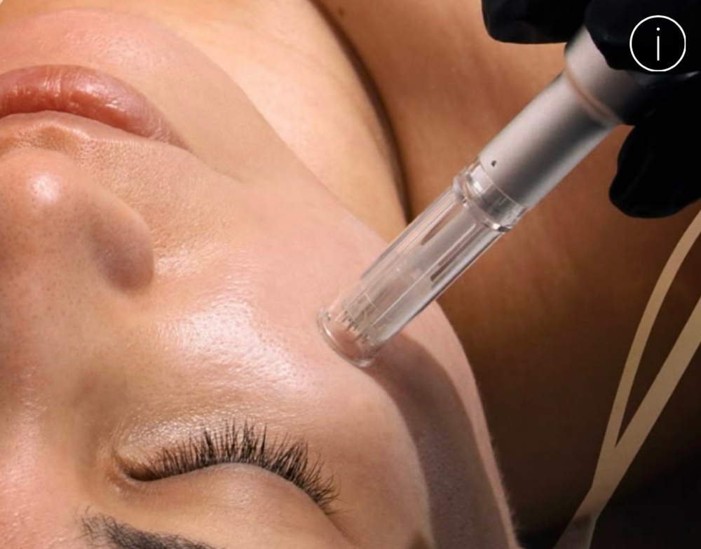 Microneedling