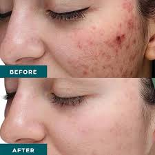 20% Lactic Peel w/ Kojic & Arbutin