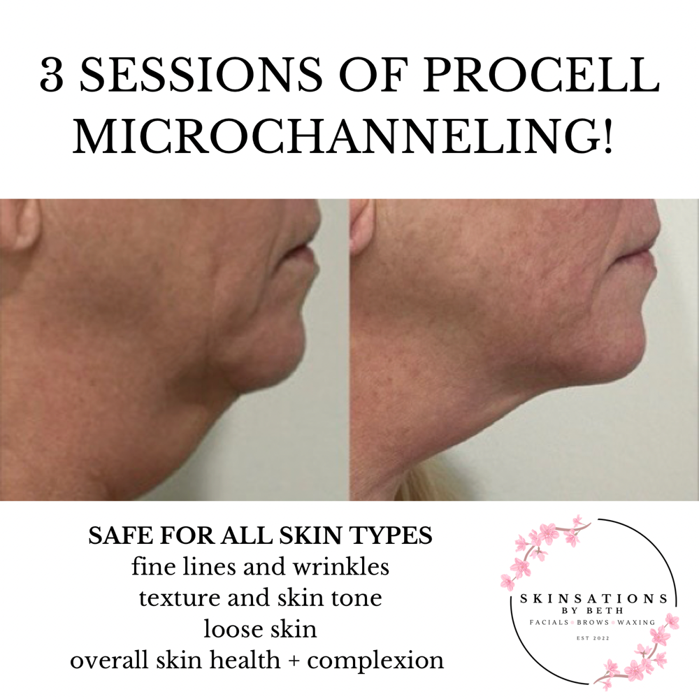 Procell Microchanneling