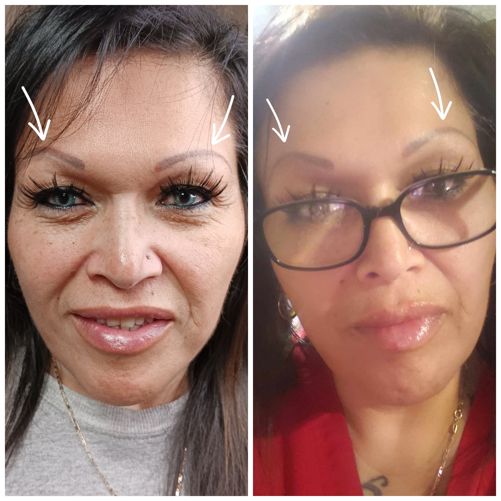 Brow Lift (Botox)