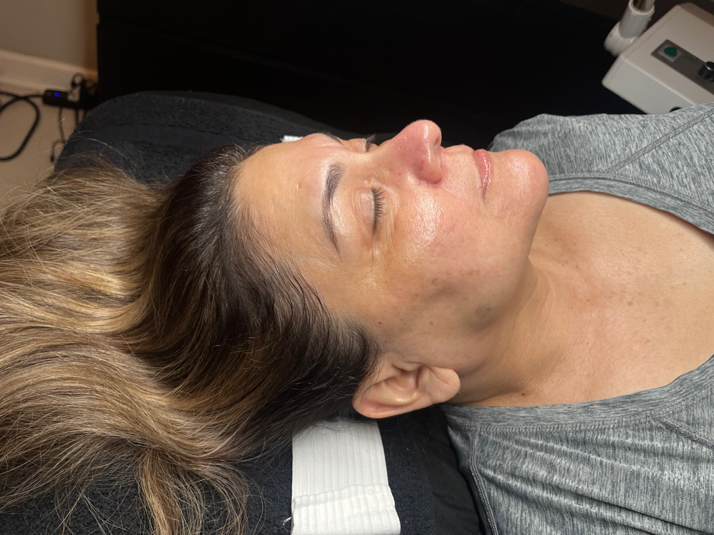 Microdermabraison + Peel
