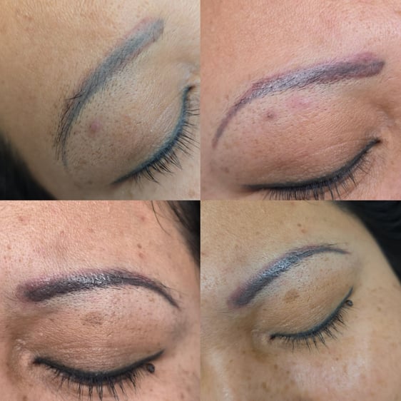 Removal Brows by Plasma