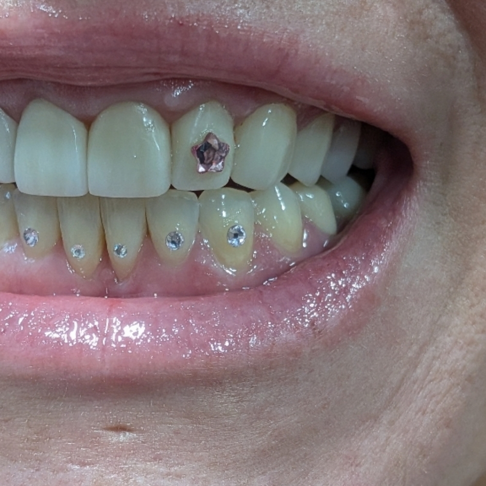 1 Medium Tooth Gem Application