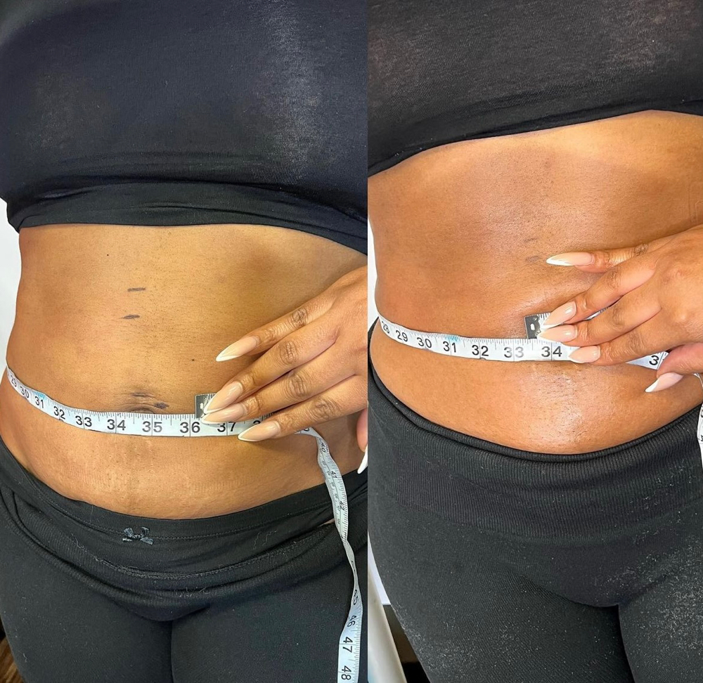 Laser Lipo,Lipo Cavitation5(series