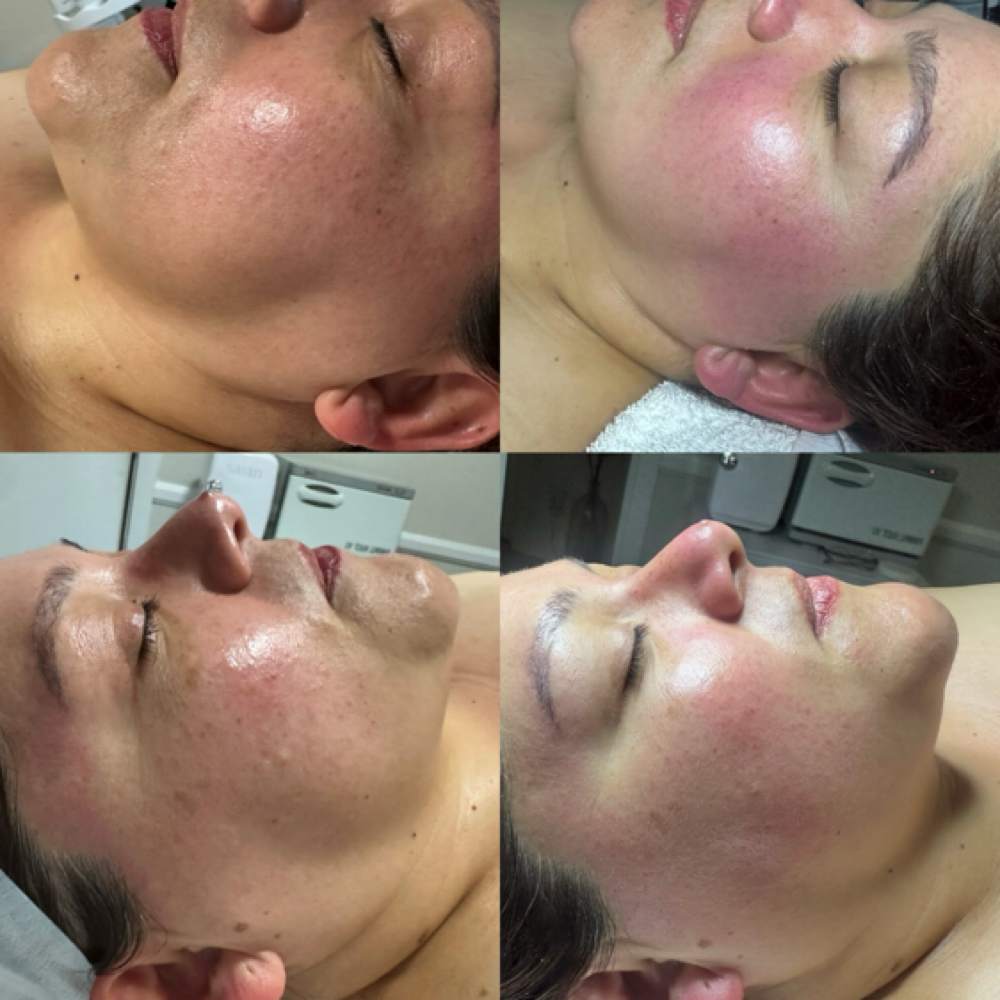 MicroLift Lux Facial at Skin by Marcela in Riverside, CA