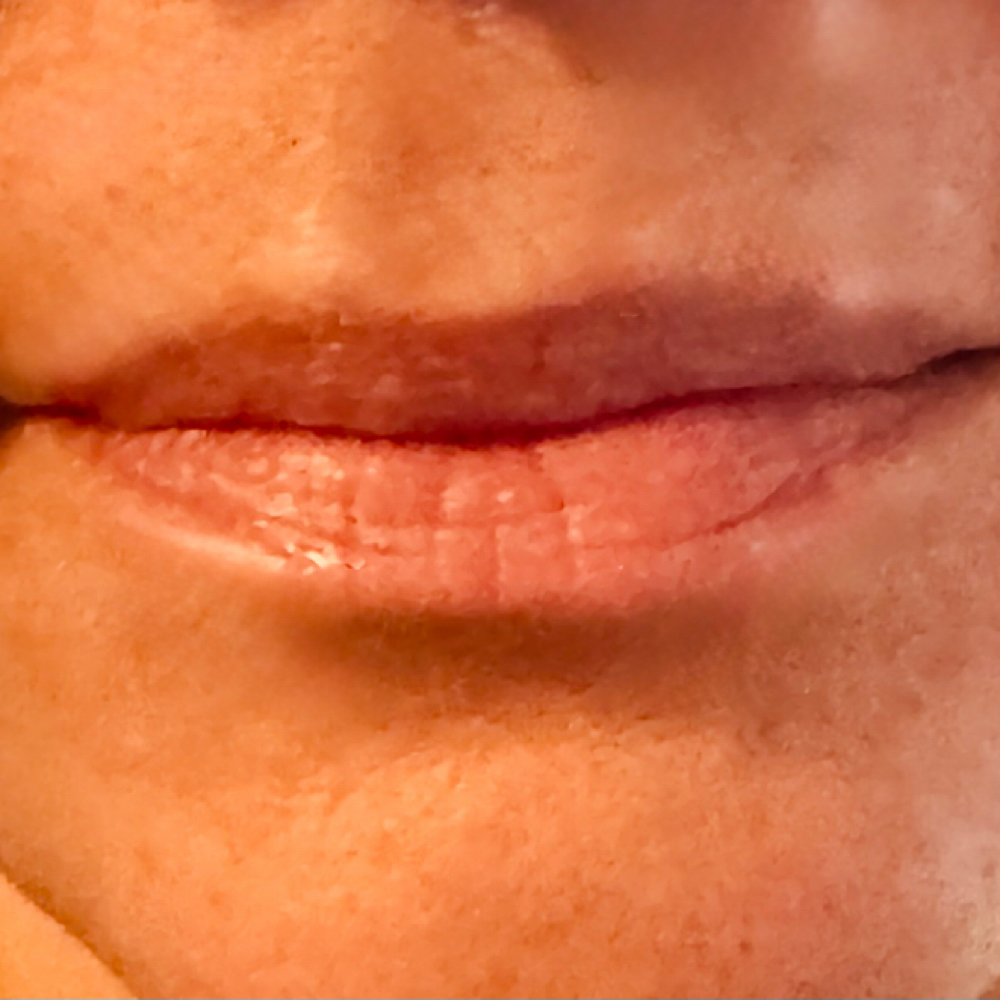 Lip Flip at Hypnotic Aesthetic in Lavon, TX